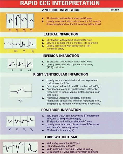 prwp ecg|abnormal ecg interpretation.